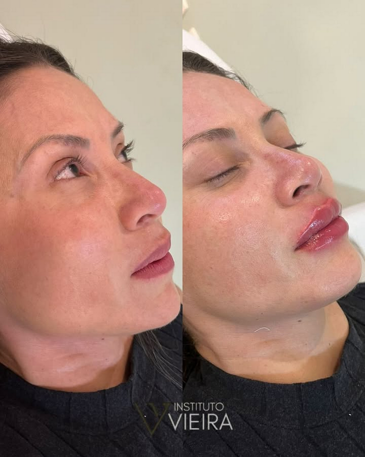 Antes e Depois de Procedimento Labial